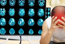 неврологічні захворювання